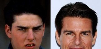 Hangi Ünlüler Gülüşünü Estetik Operasyonlara Borçlu? Hangi